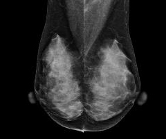 유방촬영술 (Mammography)