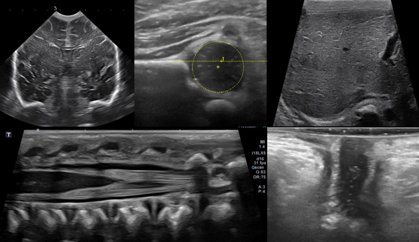 초음파 검사 (Ultrasonography)