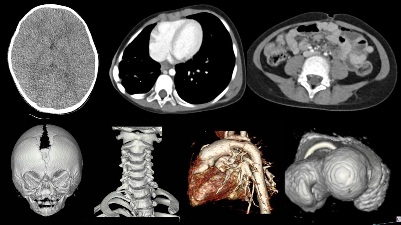 전산화 단층촬영 (CT, computed tomography)