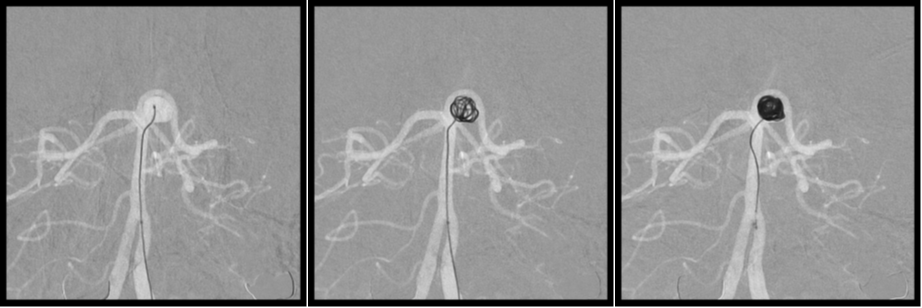 뇌동맥류 코일 색전술 (Intracranial aneurysm coil embolization)