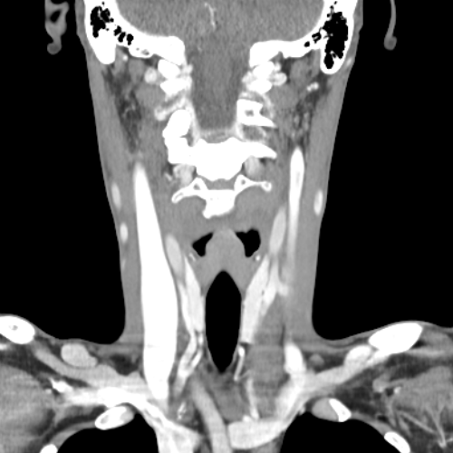 전산화단층촬영 (Computed Tomography: CT)