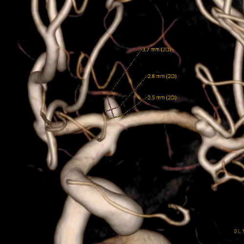 혈관조영술 (Digital Substraction Angiography)